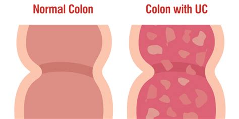 Ulcerative Colitis Normal Colon And Uc Colon Diagram Exeter Gut Clinic