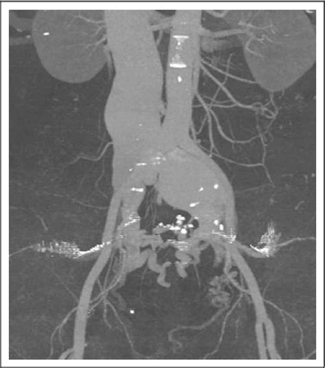 Figure From Endovascular Treatment Of An Iatrogenic Large Vessel