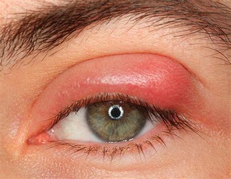Swollen Eyelids Paddy Kalish Od Optometrist