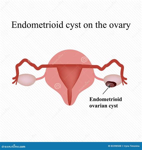Endometrioid Cyst On The Ovary Endometriosis Infographics Vector