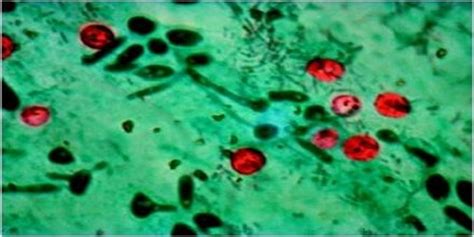 Are parasites the cause of your ibs symptoms? Cryptosporidiosis - Assignment Point