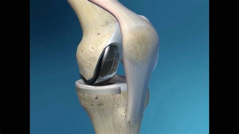 Premier Orthopaedics Partial Knee Replacement Youtube