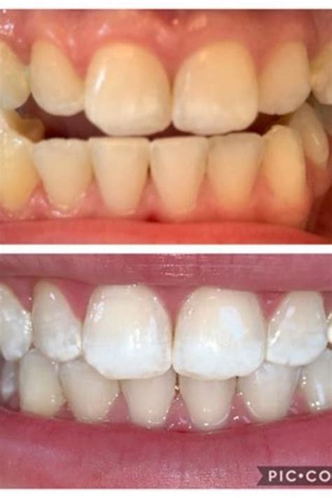 Pin On Teeth Whitening