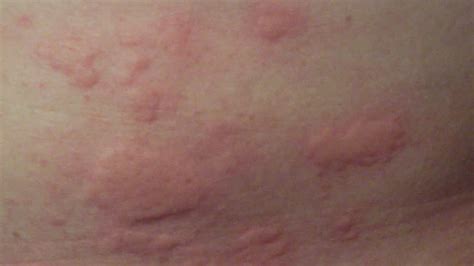 Published on february 6, 2019 by: Skin rash a likely symptom of COVID-19 infection in untested symptomatic patients, claims study ...