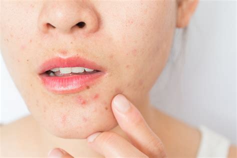 What Is Period Acne And How To Get Rid Of It Wow 360