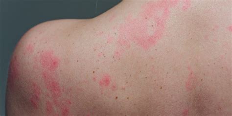 Itchy Skin And Autoimmune Disease