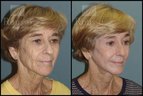 Patient 2126626 Chemical Peel Before And After Rousso Adams Facial