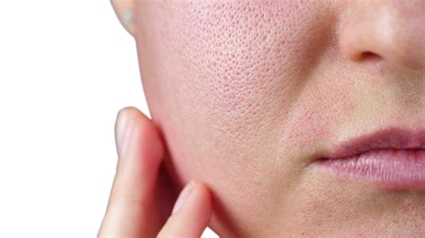Enlarged Pore Treatment Wimbledon Kensington Skin Clinics