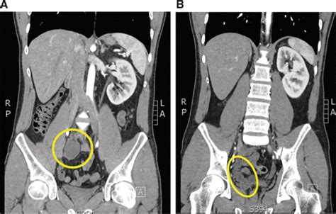 Ectopic Ureteral Insertion Into The Seminal Vesicle Causing Recurrent