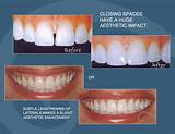 Teeth Bonding Insurance Images