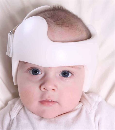 Plagiocephaly Causes Symptoms Diagnosis And Treatment