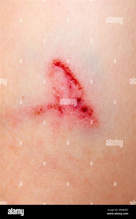 Scab Scar Hi Res Stock Photography And Images Alamy