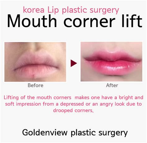 Goldenview Plastic Surgery Mouth Corner Lift Is Korea Lip Plastic