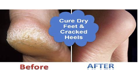 How To Treat Dry Cracked And Itchy Feet Naturally Lets Share