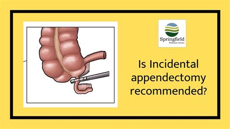 is incidental appendectomy recommended dr maran talks about appendectomy youtube