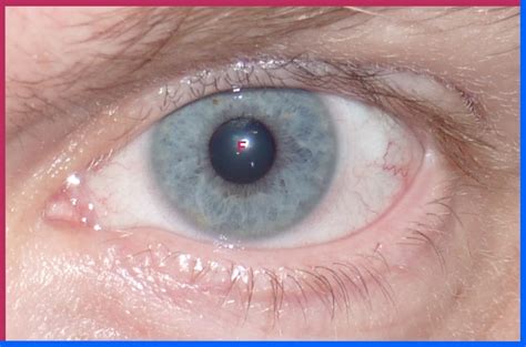 A red spot on the eye is rarely a medical emergency. red spot on eyelid - pictures, photos