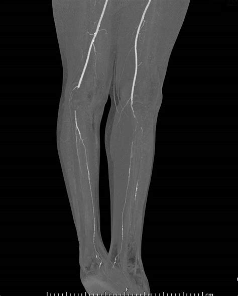 Cureus A Rare Case Of Bilateral Popliteal Artery Occlusion