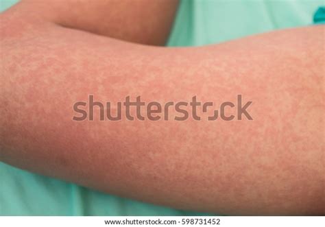 Skin Rash On Left Leg Stock Photo Edit Now 598731452