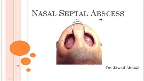 Nasal Septal Abscess Youtube