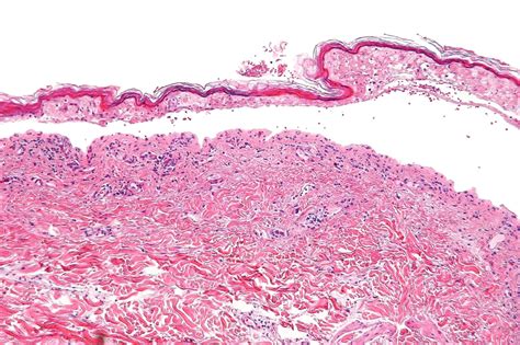 Stevens Johnson Syndrome Sjs And Toxic Epidermal Necrolysis Ten