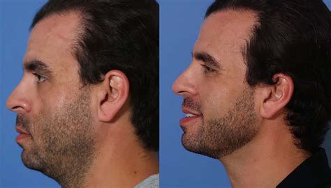 Facetite Before And After Photos Dr Timothy Minton