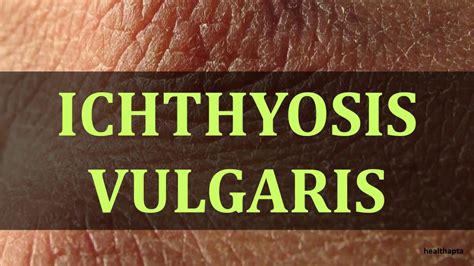 Ichthyosis Vulgaris Youtube
