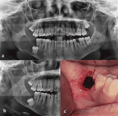 Cureus Marsupialization Of Dentigerous Cysts Followed By Enucleation