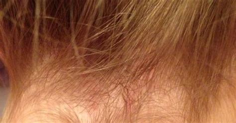 Pictures Of Lice Rashes Symptoms Of Lice Potomac Lice Ladywarning