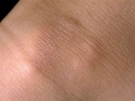 Granuloma Annulare Subcutaneous Type Perri Dermatology