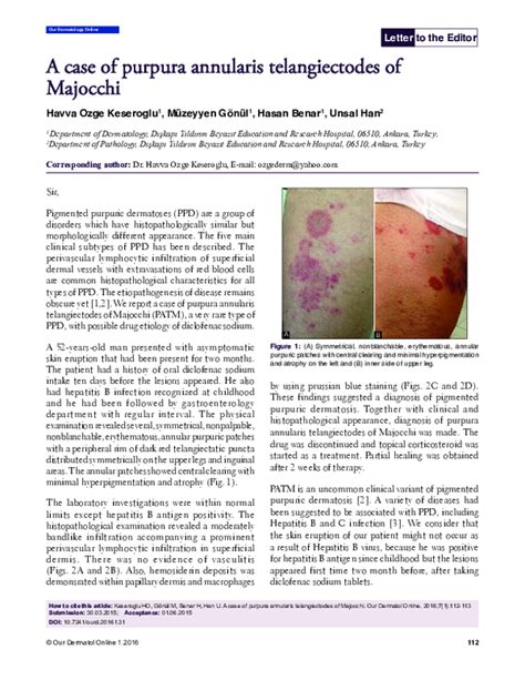 Pdf A Case Of Purpura Annularis Telangiectodes Of Majocchi Unsal