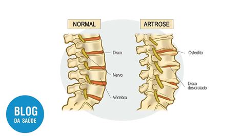 Artrose Interfacet Ria O Que E Como Tratar Blog Da Sa De