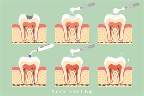 These visits give your dentist and dental hygienist the opportunity to thoroughly clean your teeth and examine them for cavities. Fillings - Papatoetoe Family Business