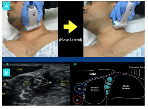 Ultrasound Guided Interscalene Brachial Plexus Nerve Block Core Em