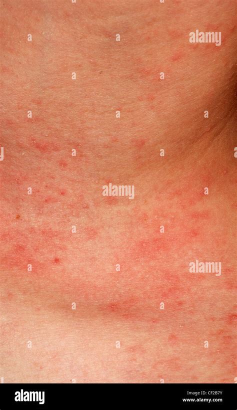 Éruption Allergique Dermatite Atopique La Texture De La Peau Du Patient