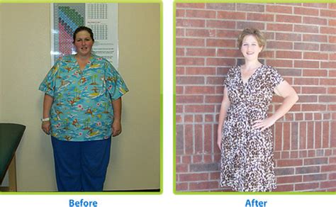 Before And After Weight Loss Surgery Licensed Under A Crea Flickr