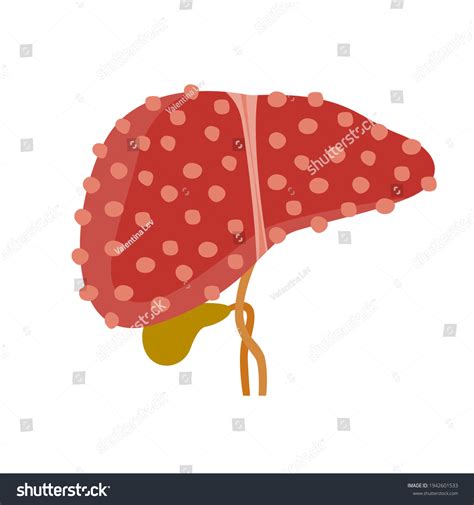 liver and liver disease cirrhosis of the liver royalty free stock vector 1942601533
