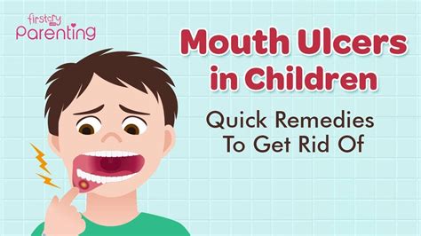 This is not a simple case of bacterial infection. Ulcer On Lips Treatment | Lipstutorial.org
