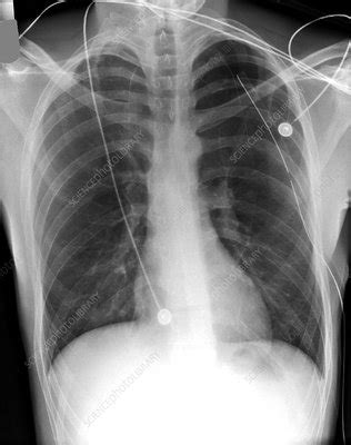 A pneumothorax can be caused by a blunt or penetrating chest injury, certain medical procedures, or damage from underlying lung disease. 'Pneumothorax treatment, X-ray' - Stock Image - C002/9542 ...