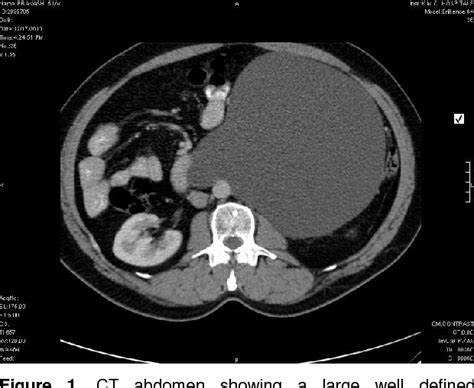 Figure 1 From Giant Cystic Retroperitoneal Lymphangioma In An Adult