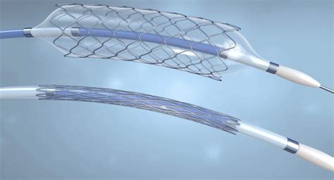 Smts Supraflex Stent Clinically At Par With Abbotts Xience With
