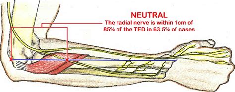 Radial Tunnel Syndrome Causes Symptoms Diagnosis And Treatment