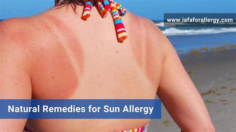 Natural Remedies For Sun Allergy Effective Treatment By Iafa®