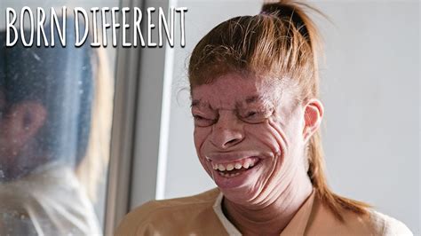 People Born Without Eyelids