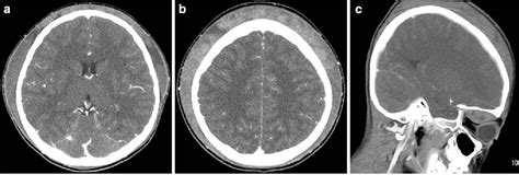 Subgaleal Hematoma Presenting As A Manifestation Of Factor Xiii