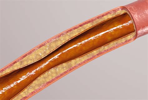 Blood Vessel Atherosclerosis 3d Model Turbosquid 1371381