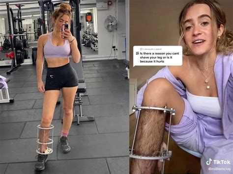 Millie Mclay Leg Woman Hits Back At Trolls Who Mocked Her For Hairy Leg She Cant Shave After