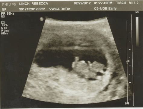 Little Baby Linch 8 9 Weeks Picture Plus Ultrasound