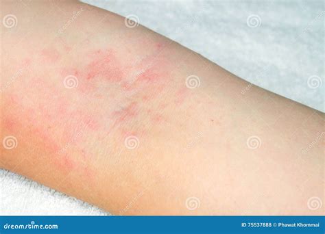 Red Rash On The Arms Stock Photography 104372870