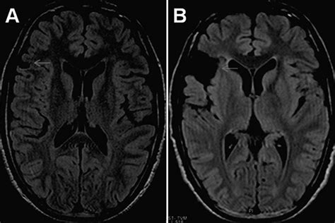 Predictors Of Seizure Outcome Following Resective Surgery