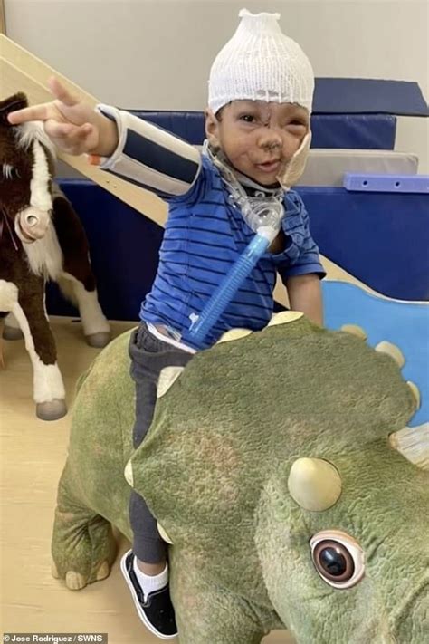 Brave Toddler Who Was Mauled By Neighbors Pit Bull That Ripped His